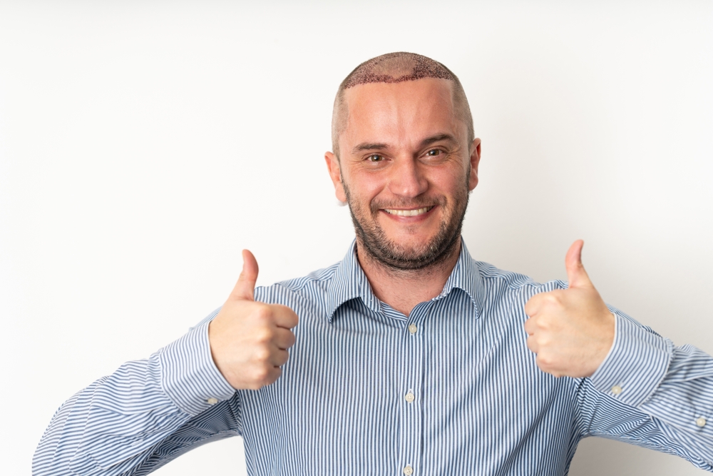 hair transplant scar