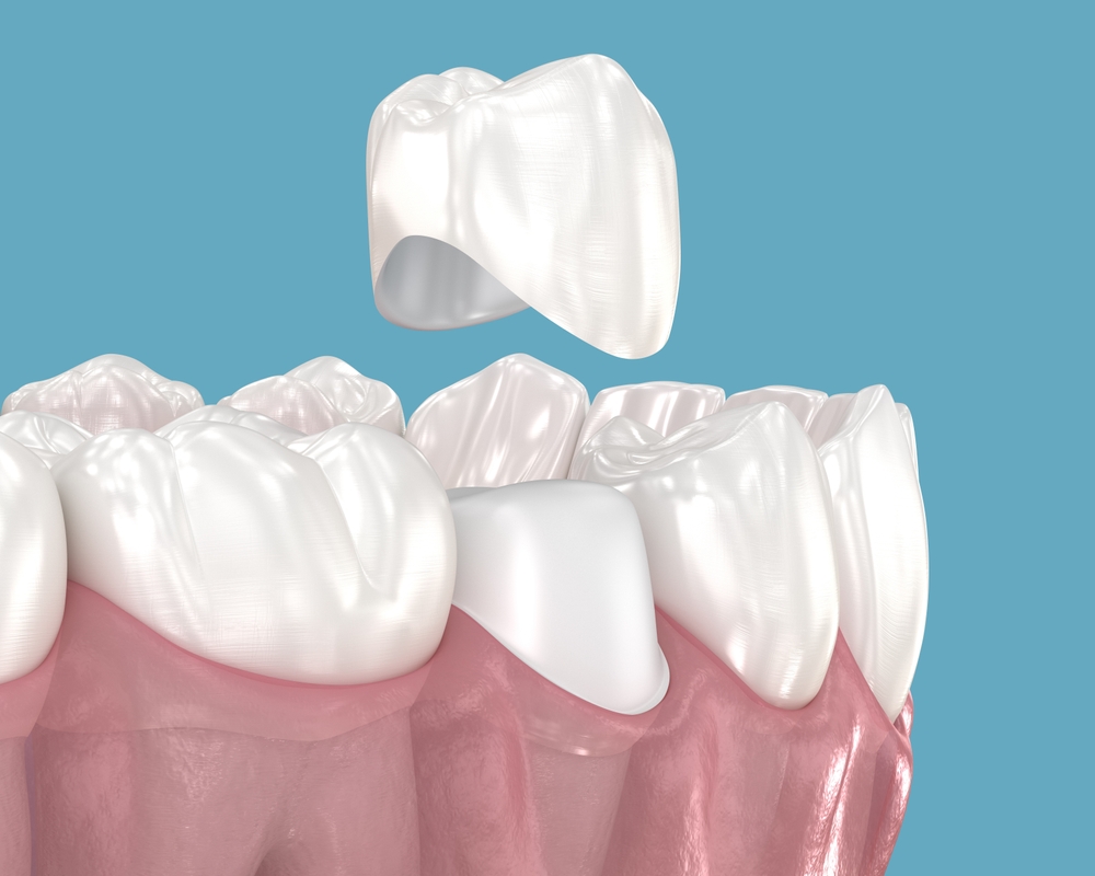 CEREC Crowns