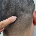 scalp mole