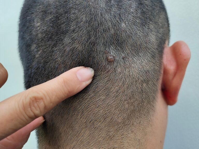 scalp mole