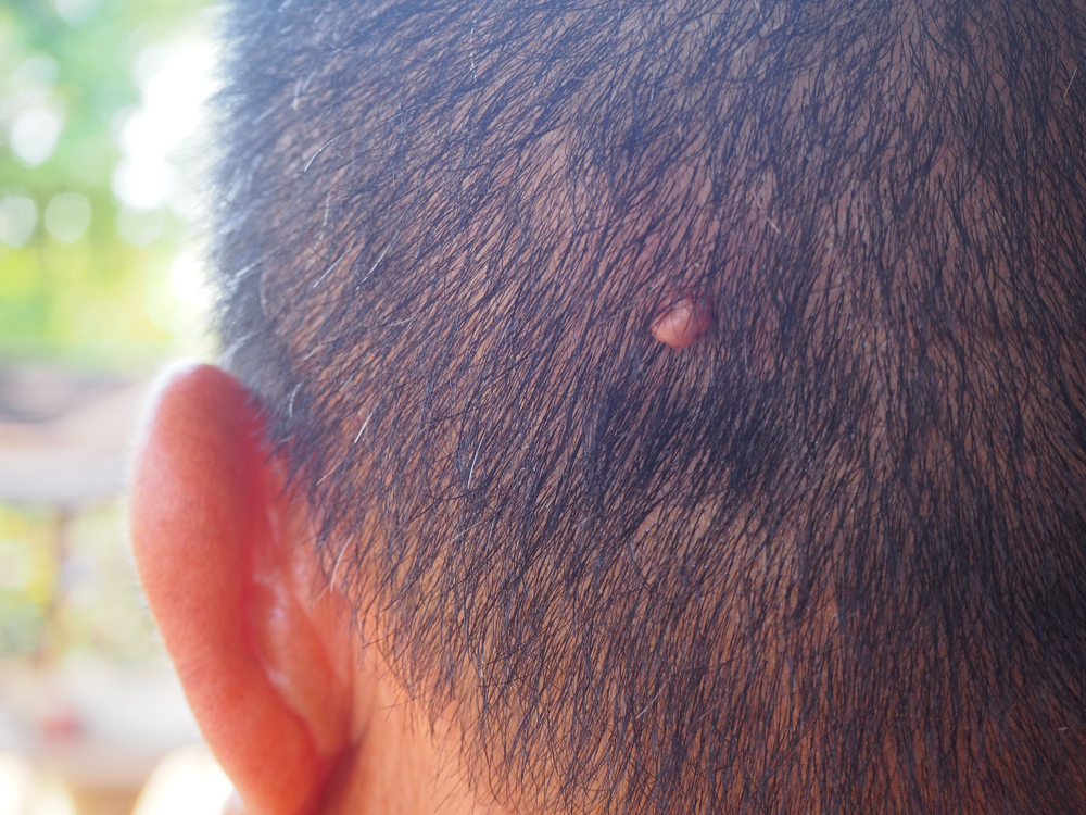 mole on scalp