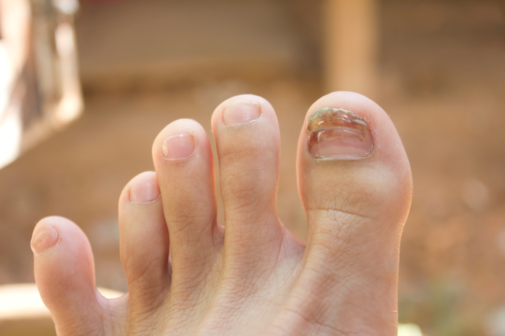 Toenails Fall Off