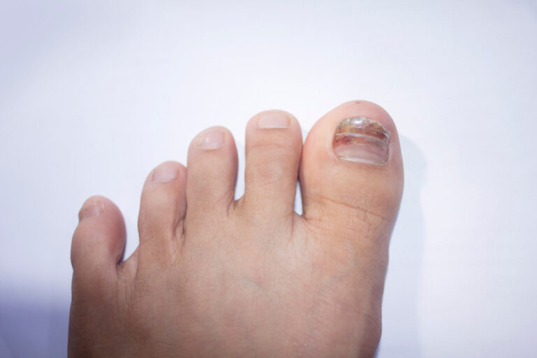 toenail falling off