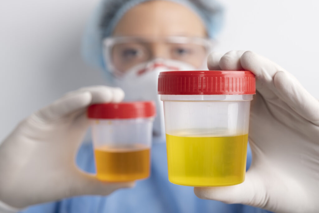 occult blood in urine