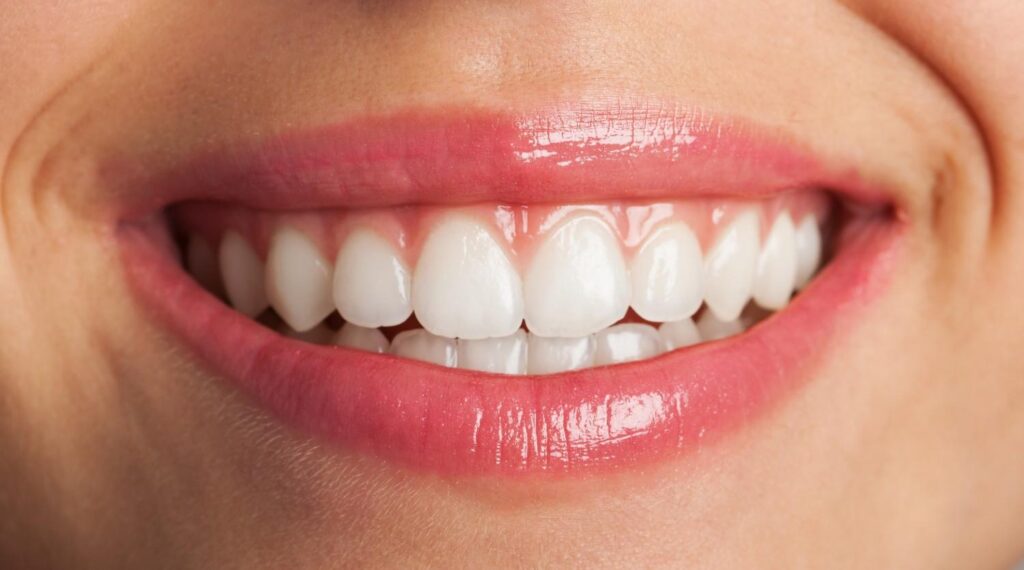 Composite Veneers