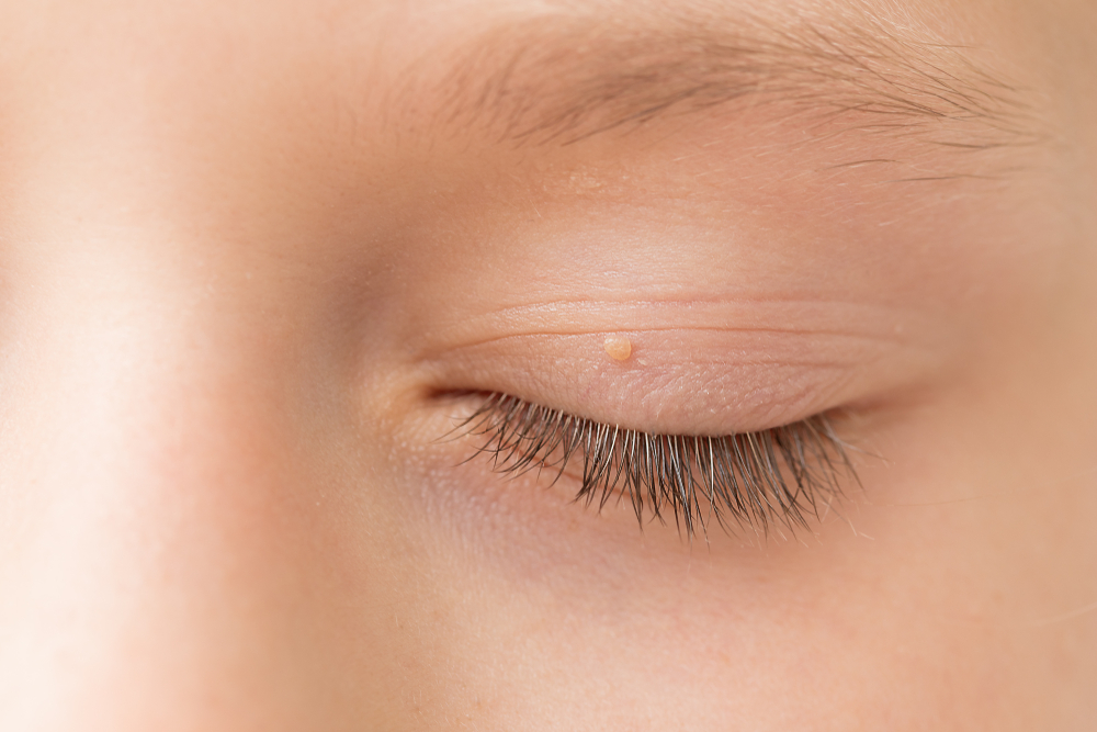 Skin Tag on Eyelid