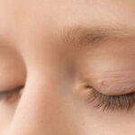 Skin Tag Eyelid