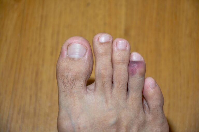 Sprained Toe