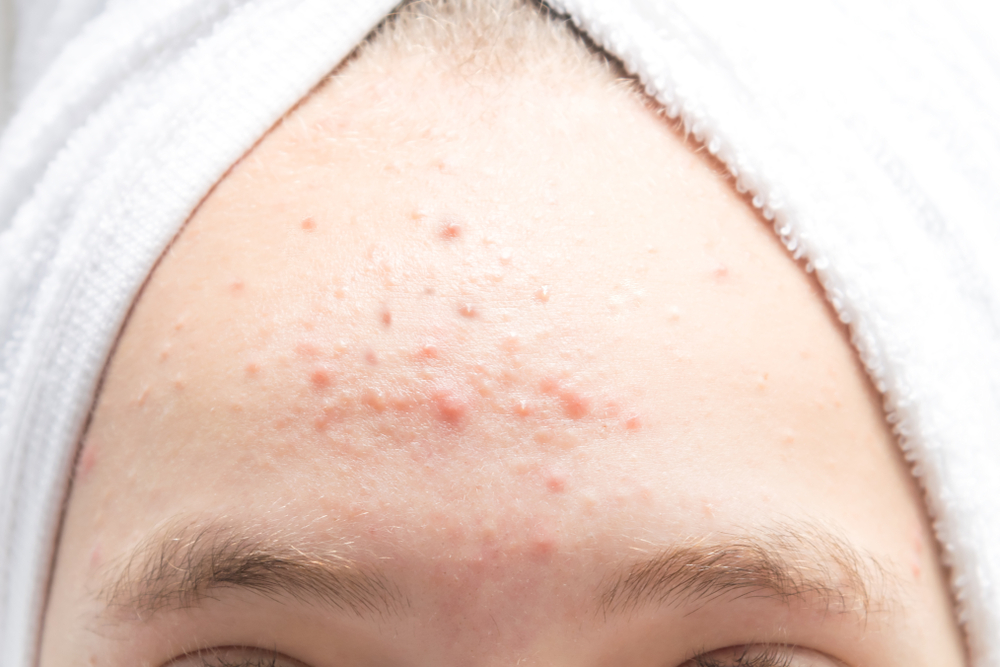 Forehead Acne