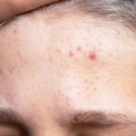 forehead pimples