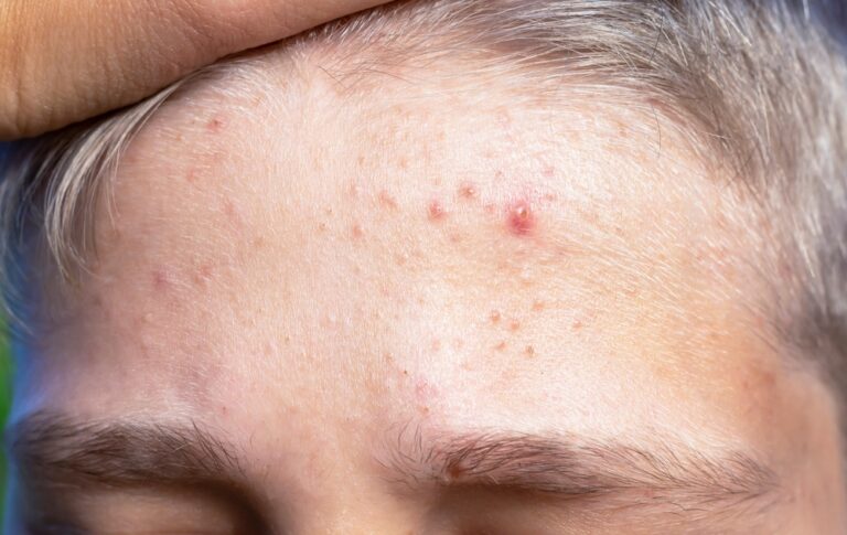 forehead pimples