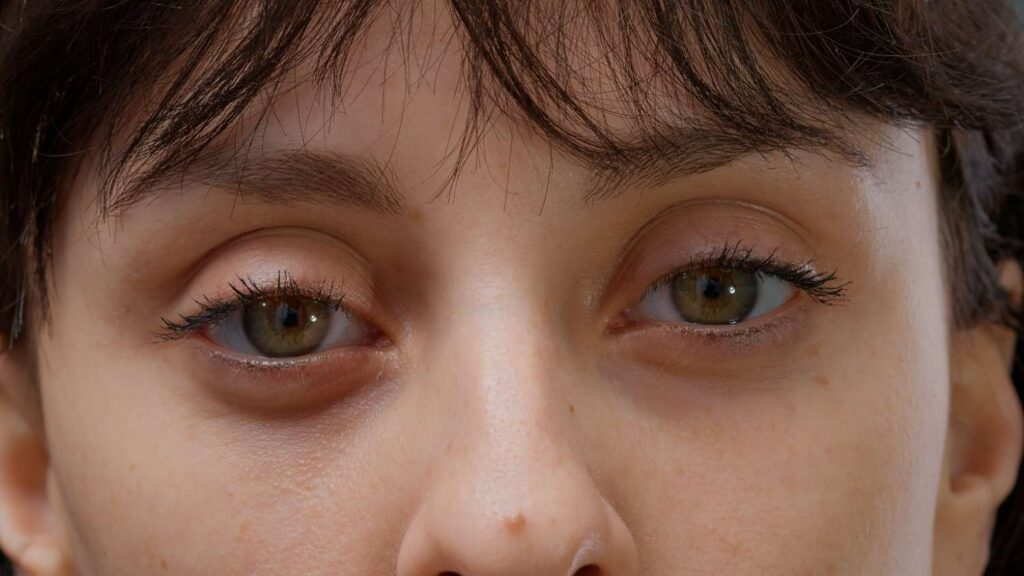 Woman showing sunken eyes and hollow under-eye area caused by fatigue and dehydration