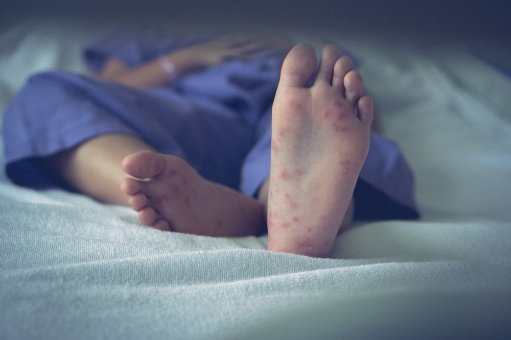 Bottom of a foot with red spots and mild redness that may be caused by friction, eczema, or a fungal infection.