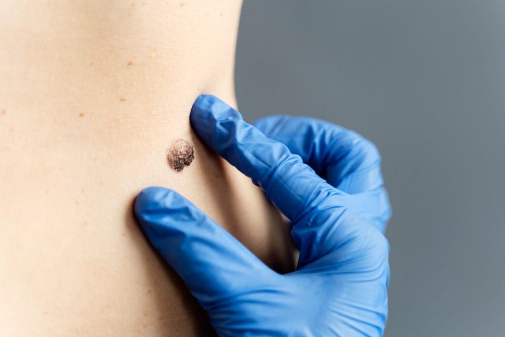 Cancerous-Skin-Tag-Pictures