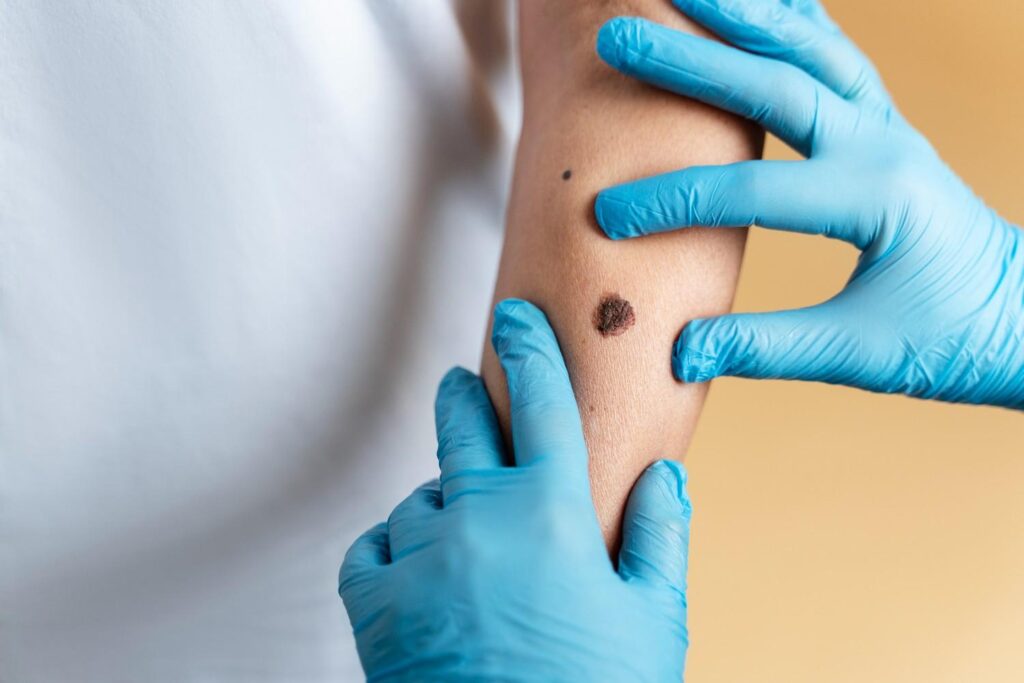 Skin-Tags-Be-Cancerous