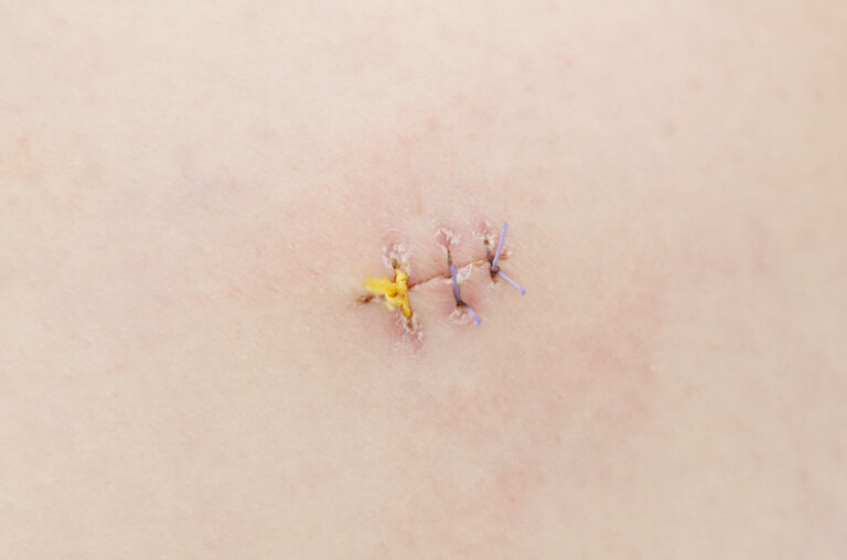 Close-up of dissolvable stitches on a healing surgical incision with minimal redness.