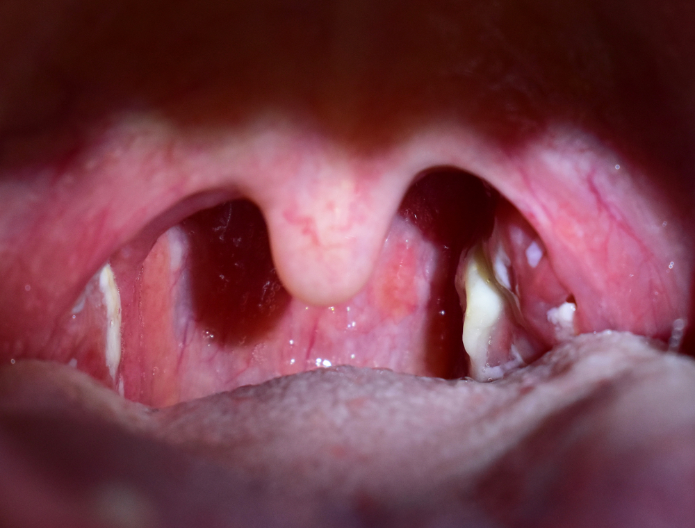 Doctor explaining treatment options for white spots on tonsils.