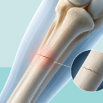 Medical illustration showing a hairline fracture with a small crack in the bone.