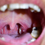 Illustration showing white spots on inflamed tonsils caused by strep throat, tonsillitis, or tonsil stones.