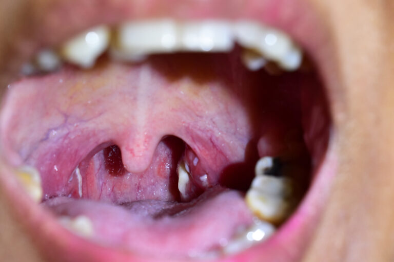 Illustration showing white spots on inflamed tonsils caused by strep throat, tonsillitis, or tonsil stones.