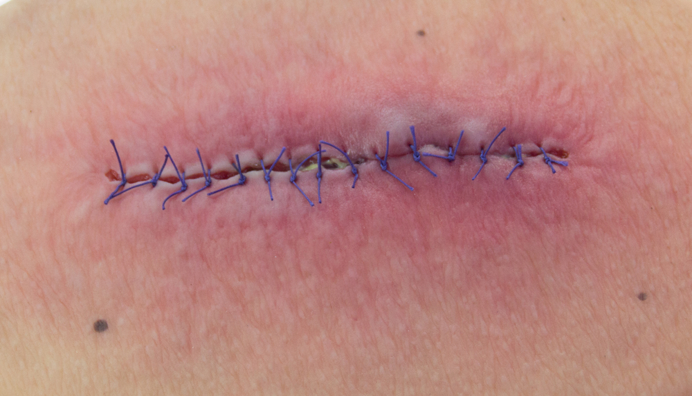 Healing surgical incision with dissolvable stitches showing normal wound closure and recovery.