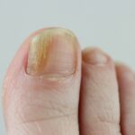 Toenail fungus showing yellow discoloration and nail changes