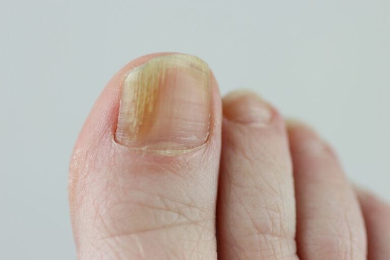 Toenail fungus showing yellow discoloration and nail changes