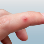 Pimple on finger showing a small red inflamed bump