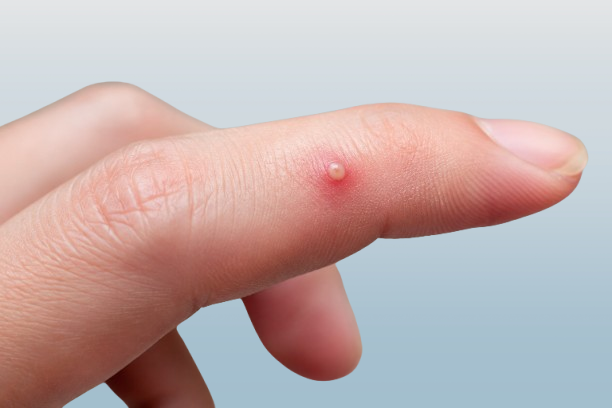 Pimple on finger showing a small red inflamed bump