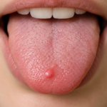 Lie bumps on tongue near the tip