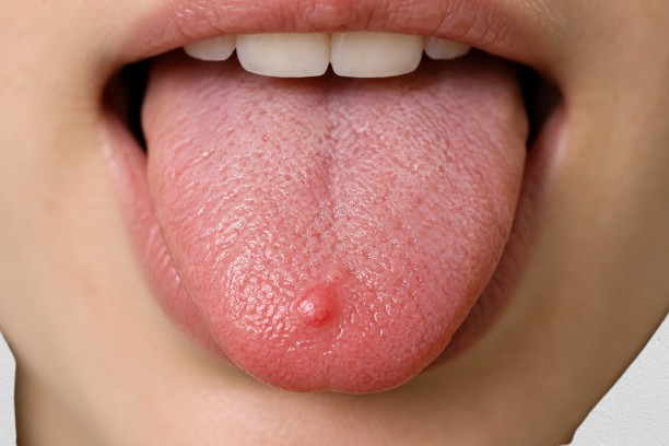 Lie bumps on tongue near the tip