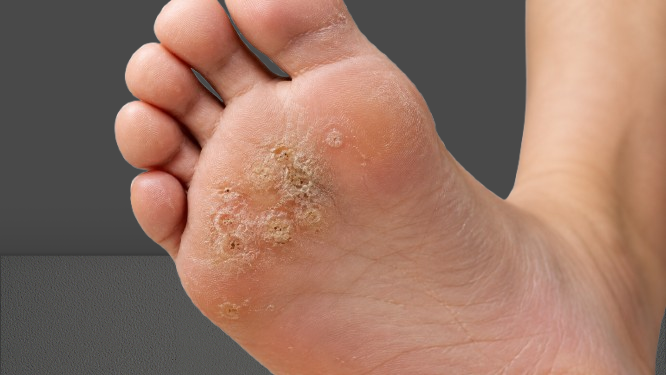 Mosaic warts forming a cluster of rough growths on the sole of a foot